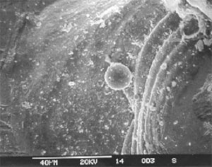 Figure 25. Globules of remelted metal within coupling gear surface pits - typical of electrical arcing damage.