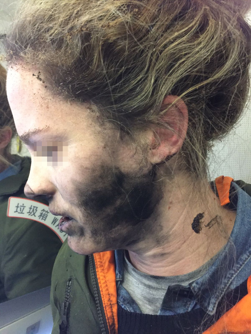 Woman injured after a pair of her own battery-operated headphones exploded